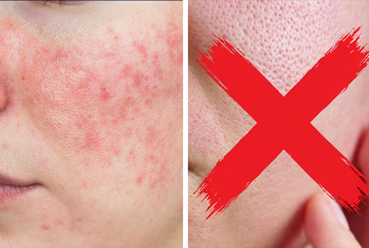 拒絕過度護膚，解鎖面部祛痘暗沉修護新方式