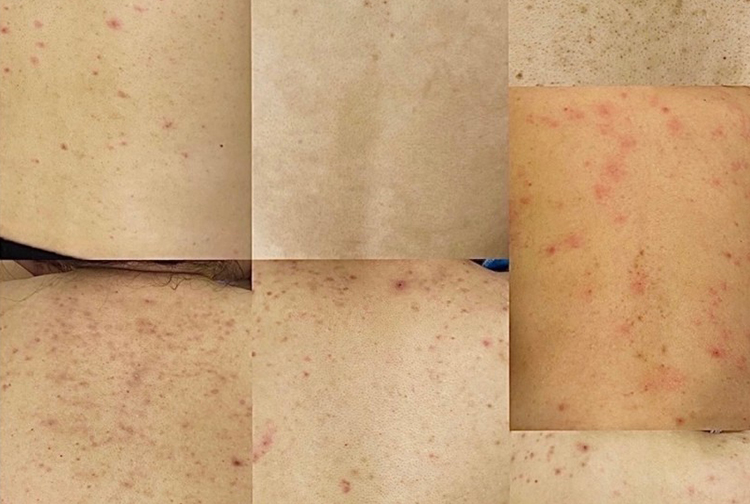 背部護膚易被忽視？Suey專屬方案，解決背部肌膚多重困擾